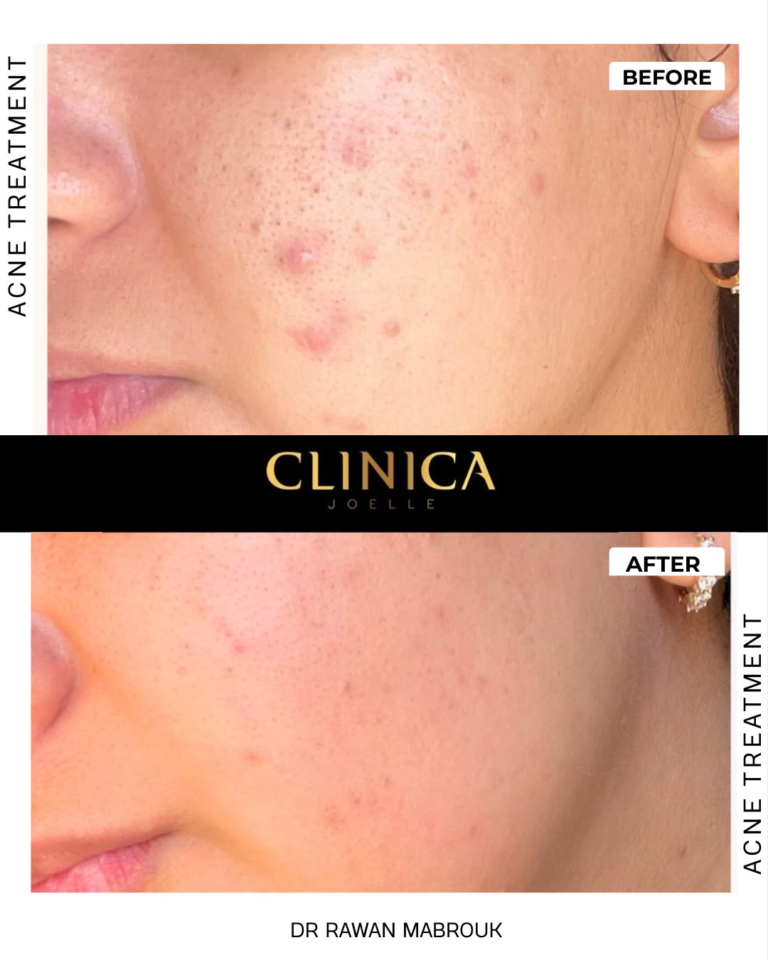 Acne treatment — before and after