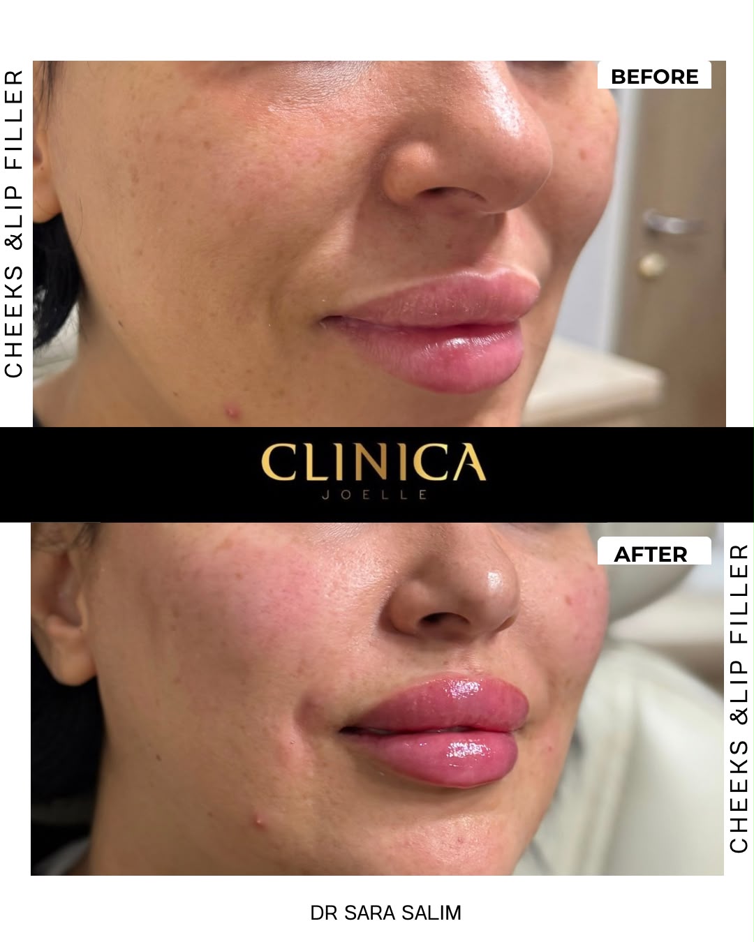 Cheeks and lip filler — before and after