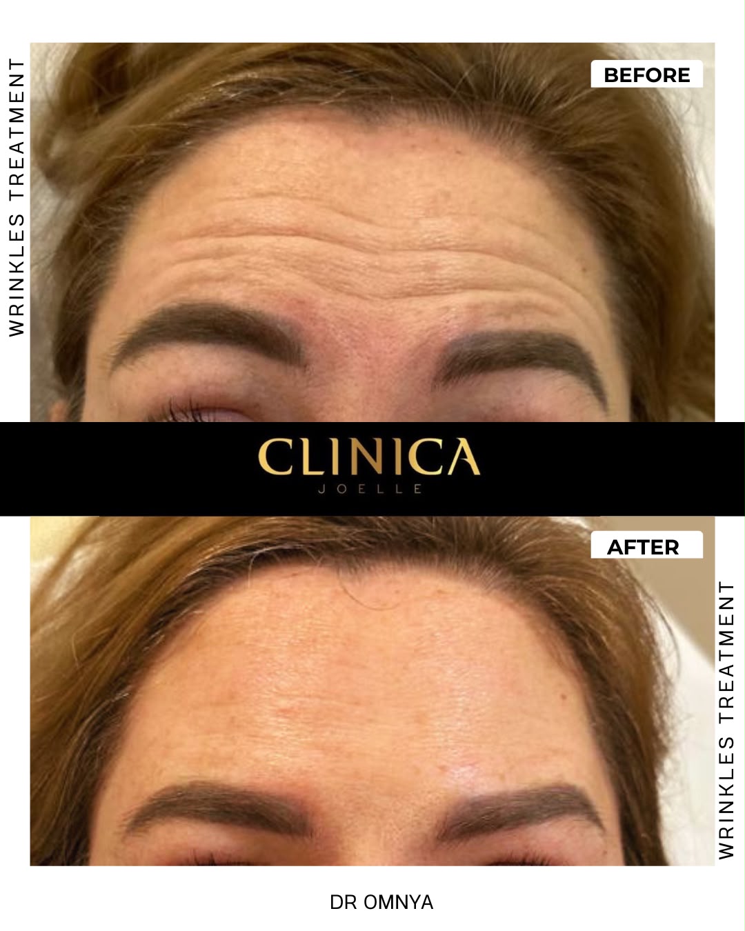 Wrinkles treatment — before and after
