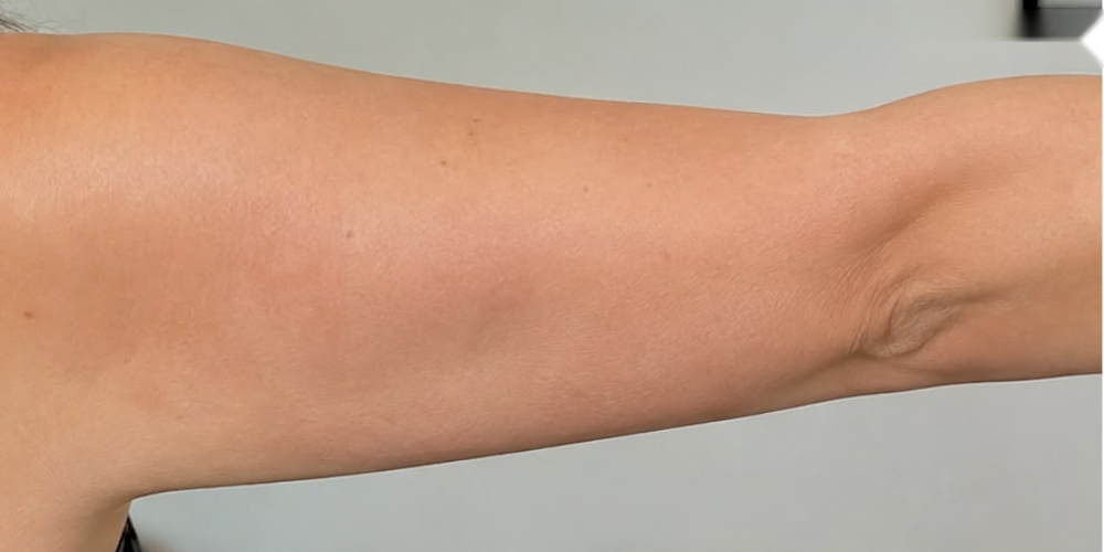 Brachioplasty — after