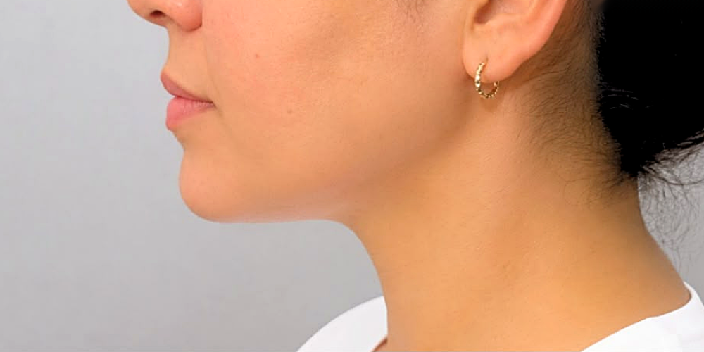 Double chin liposuction — after