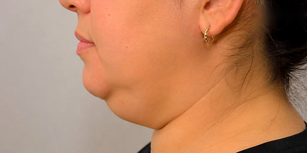 Double chin liposuction — before