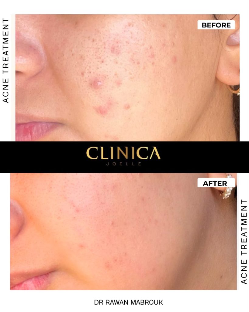 Acne treatment – before and after