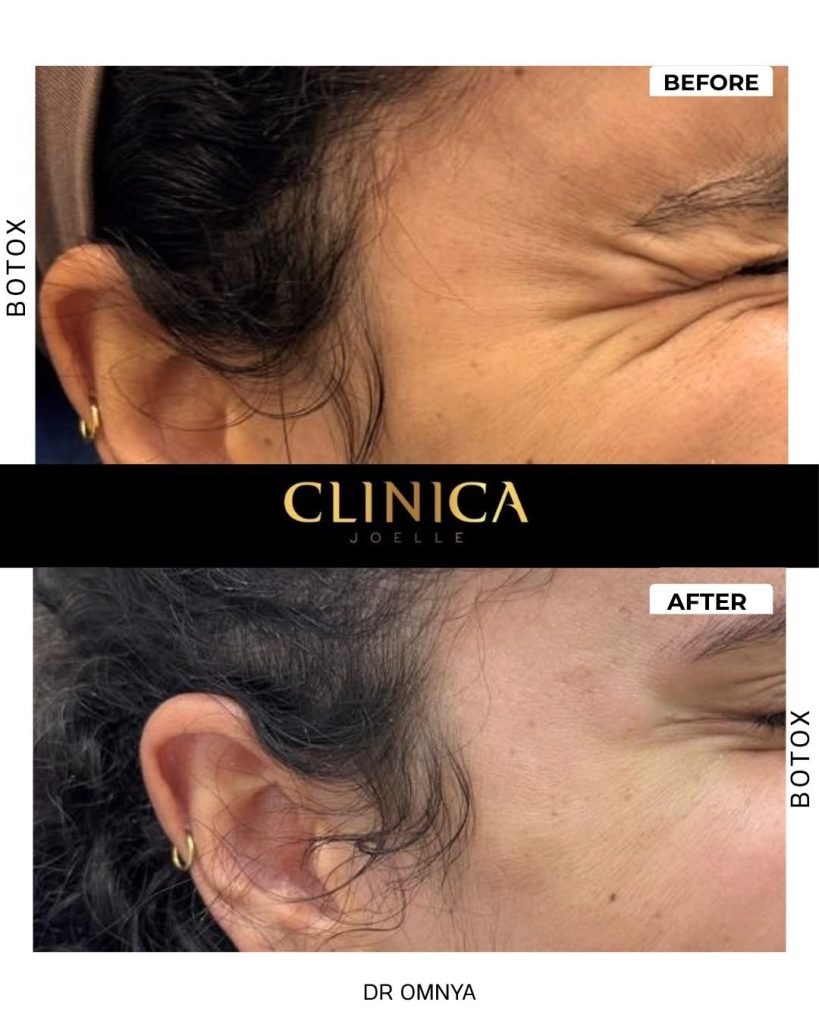 Botox – Dr Omnya