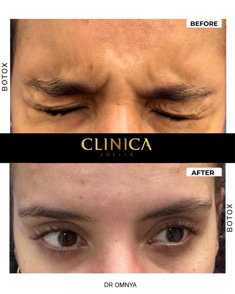 Botox II – Dr Omnya