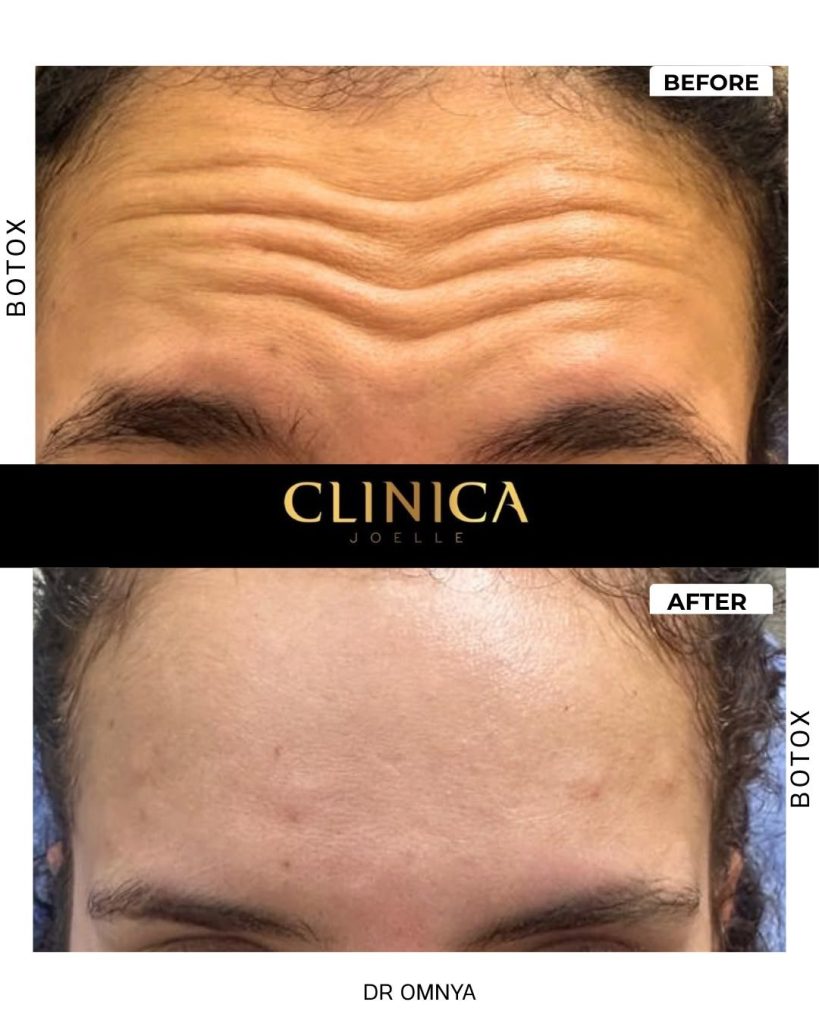 Botox III – Dr Omnya