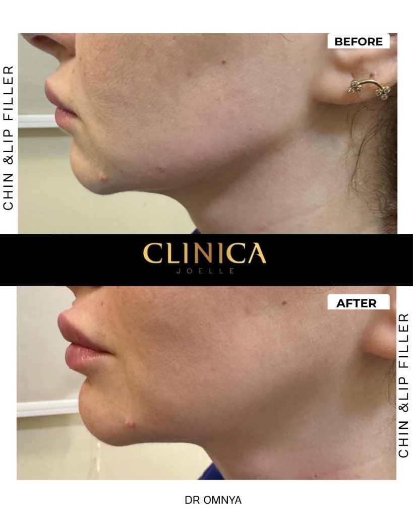 Chin and lip filler – Dr Omnya