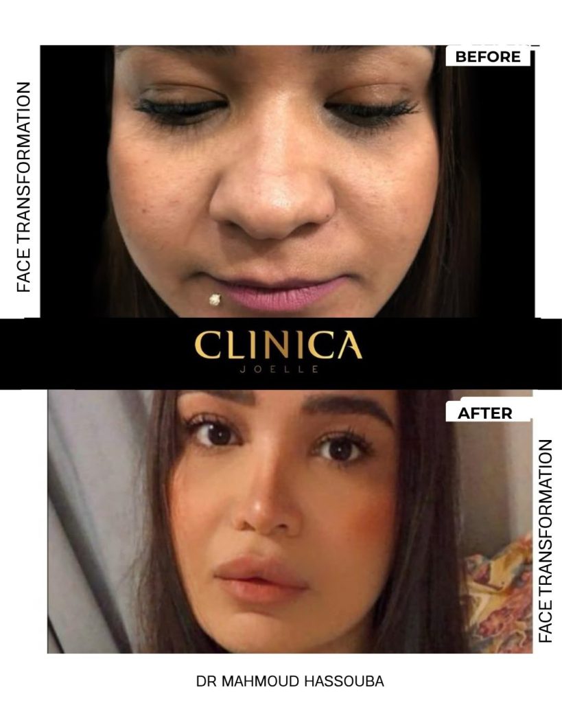 Face transformation – Dr Mahmoud Hassouba
