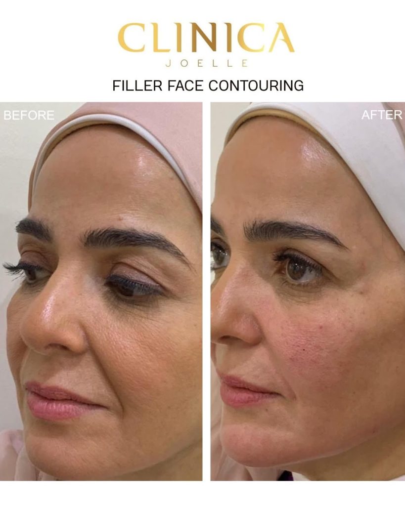 Filler face contouring