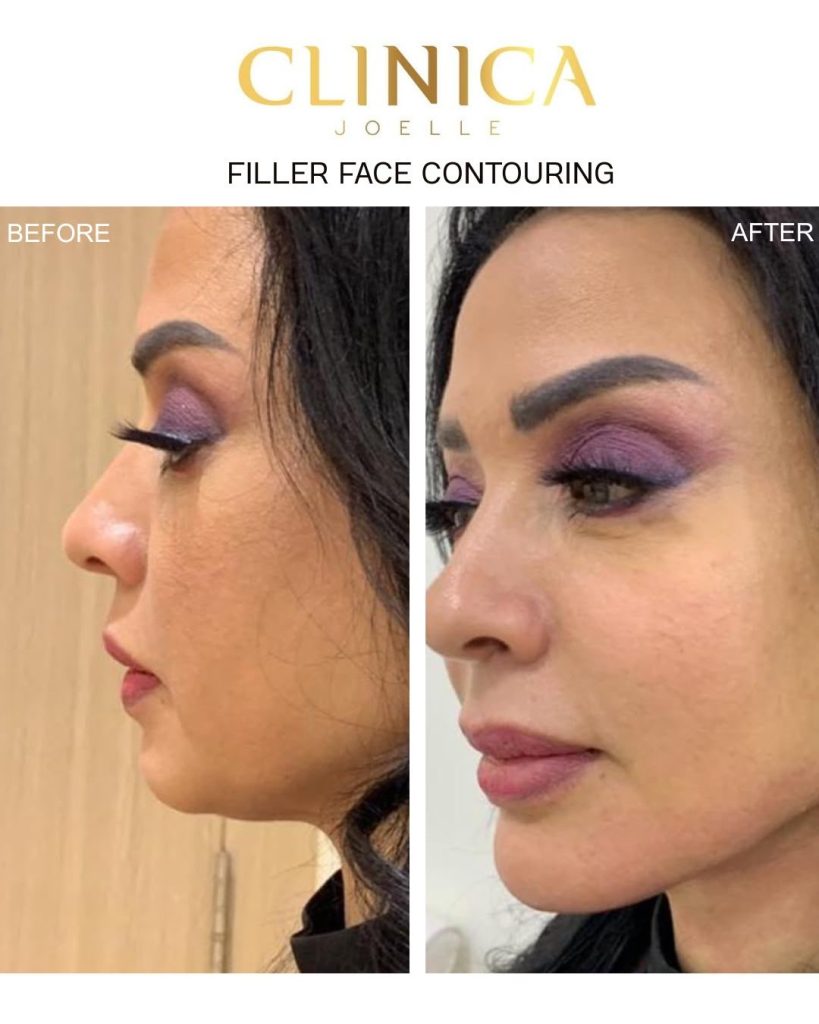 Filler face contouring II