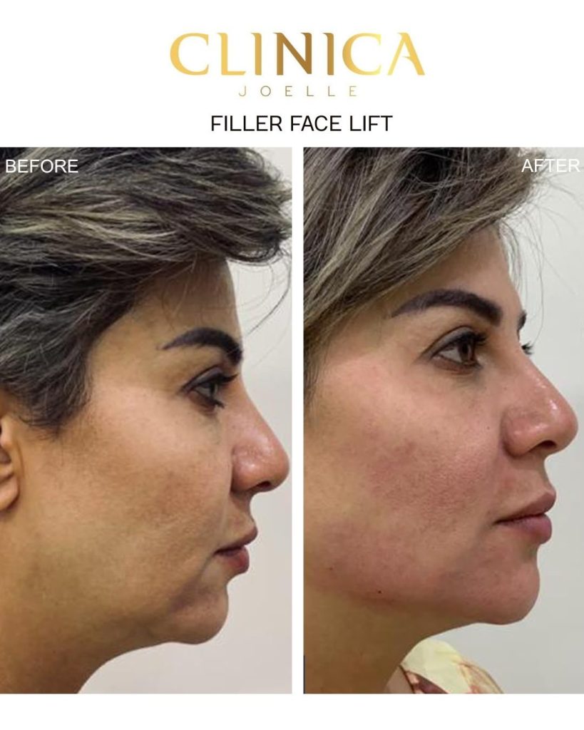 Filler face lift