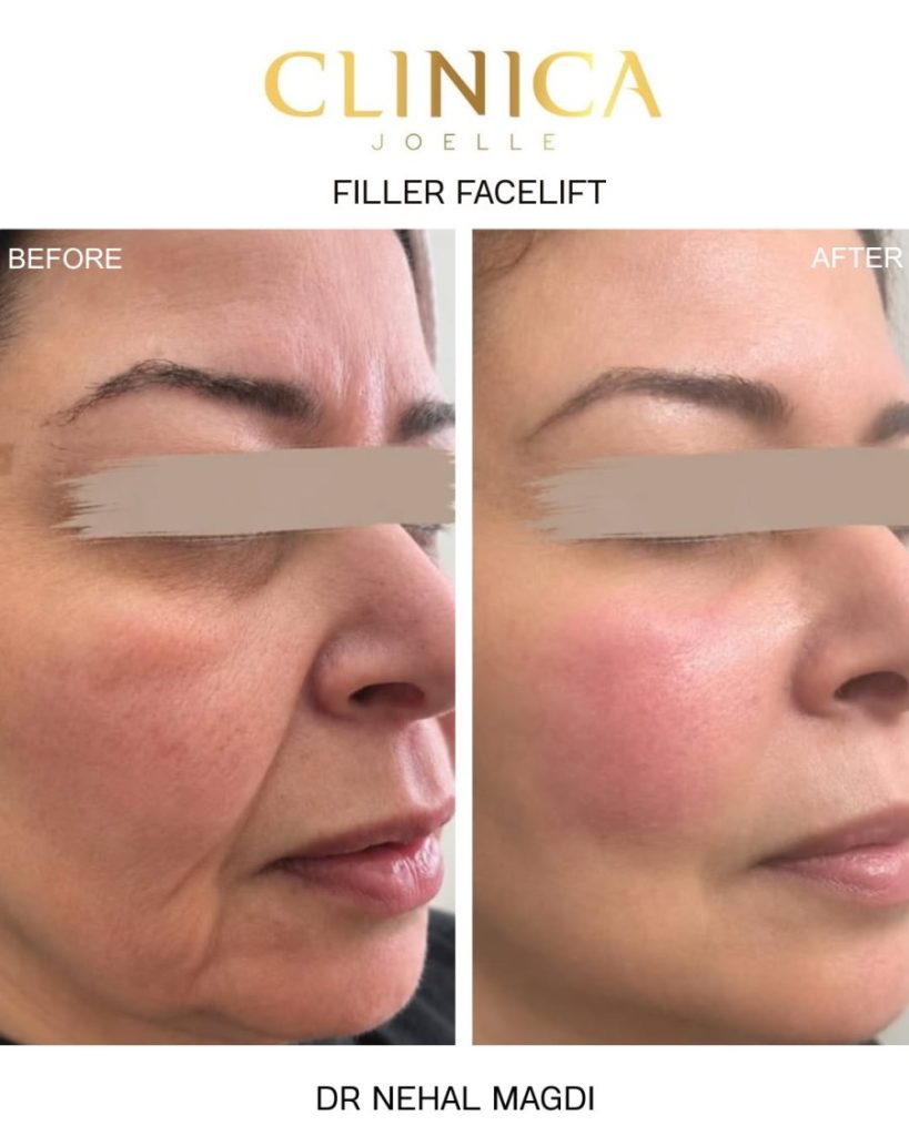 Filler facelift – before and after