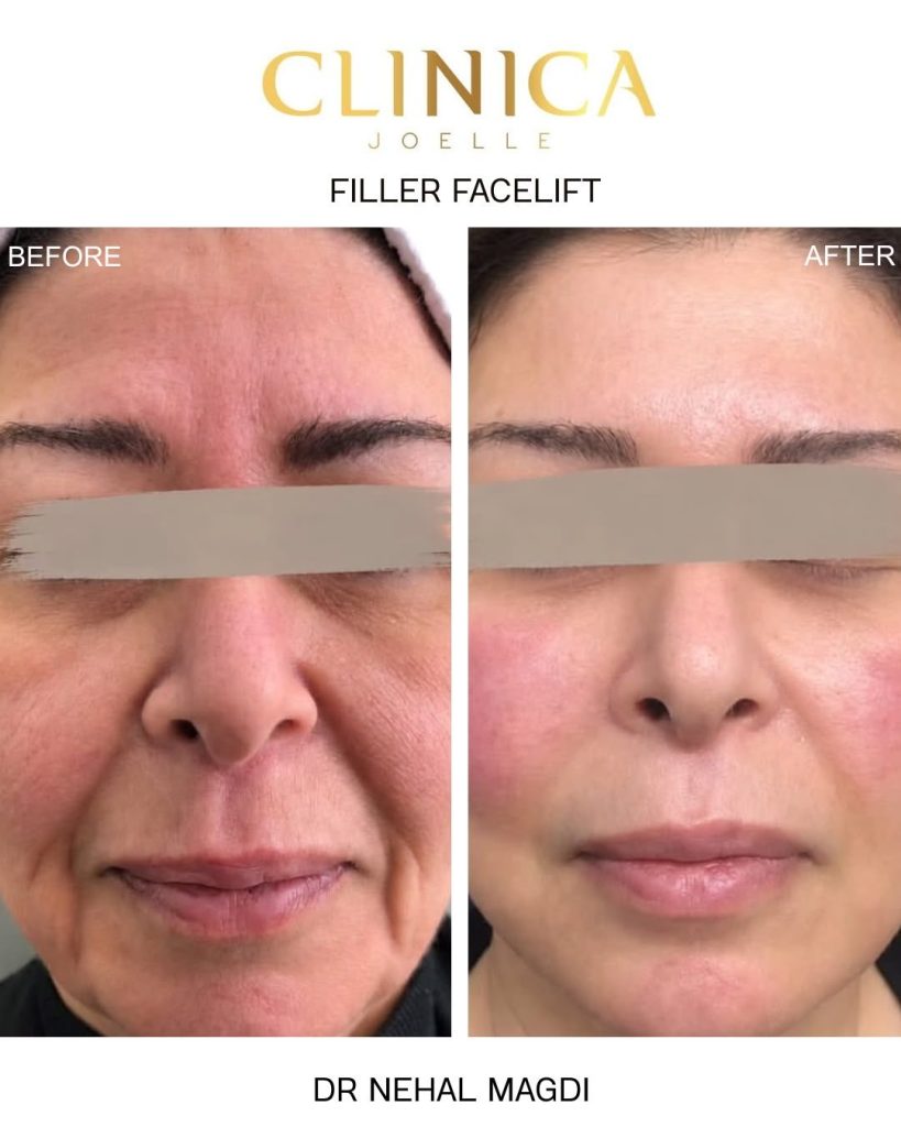 Filler facelift II – Dr Nehal Magdi