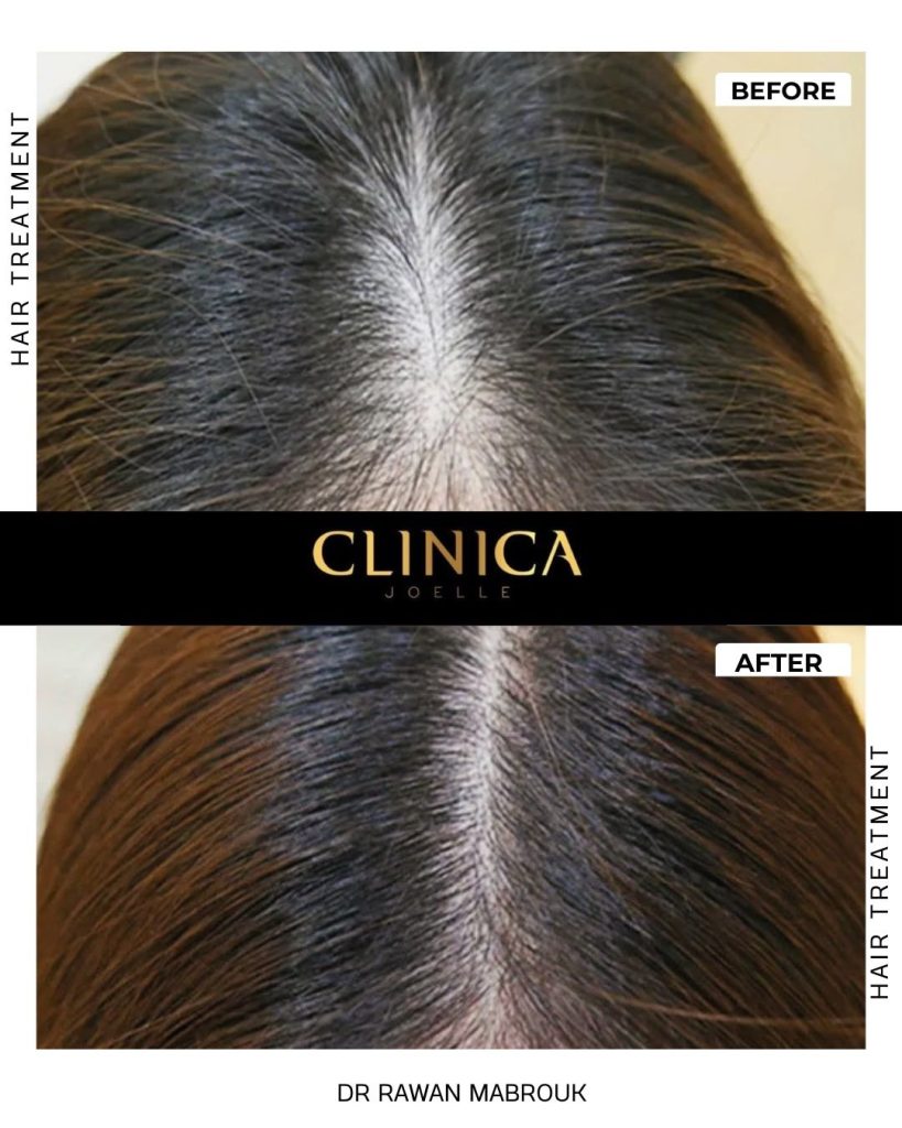 Hair treatment – Dr Rawan Mabrouk