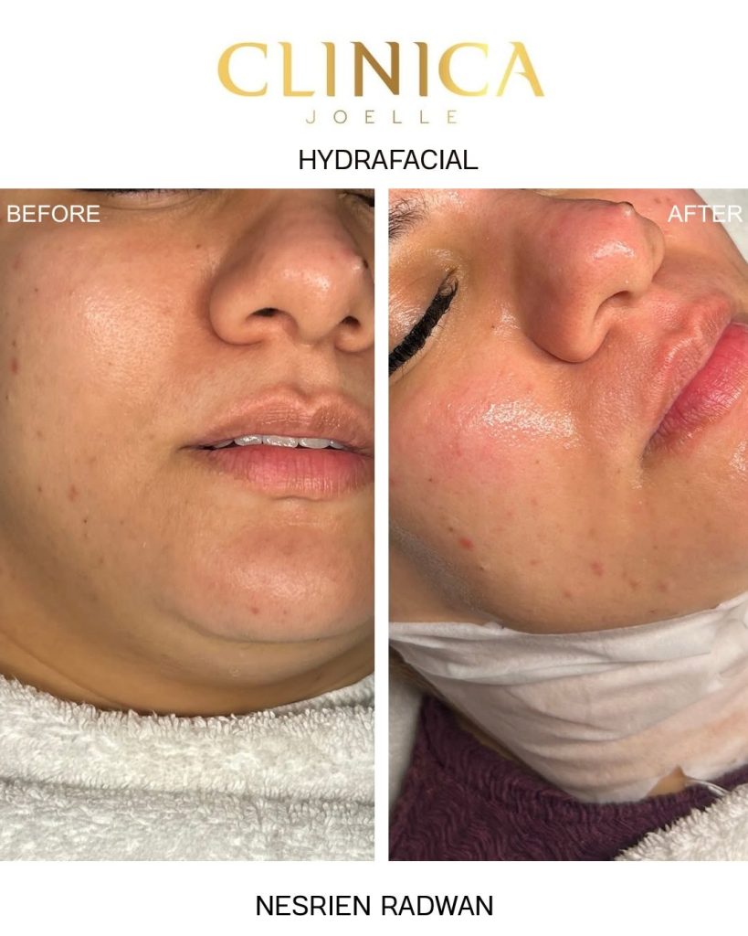 Hydrafacial – Nesrien Radwan