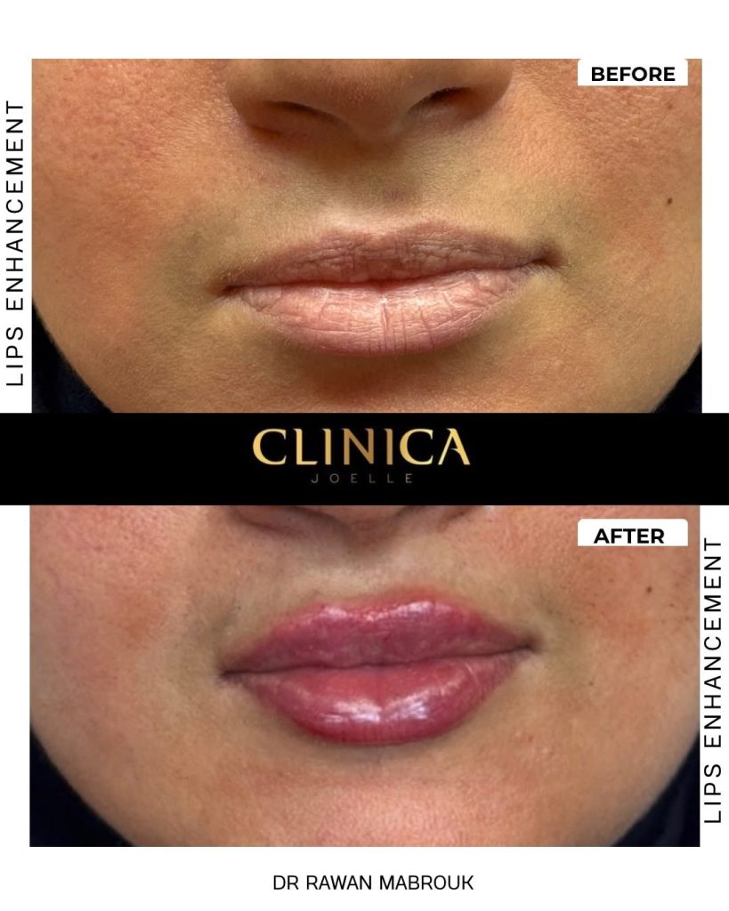 Lips enhancement – Dr Rawan Mabrouk