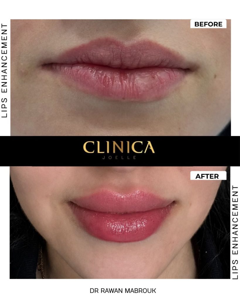 Lips enhancement II – Dr Rawan Mabrouk