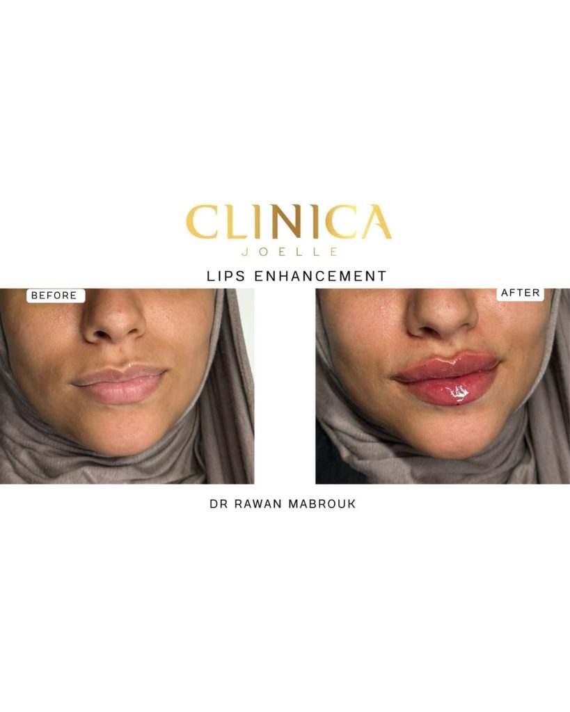 Lips enhancement III – Dr Rawan Mabrouk