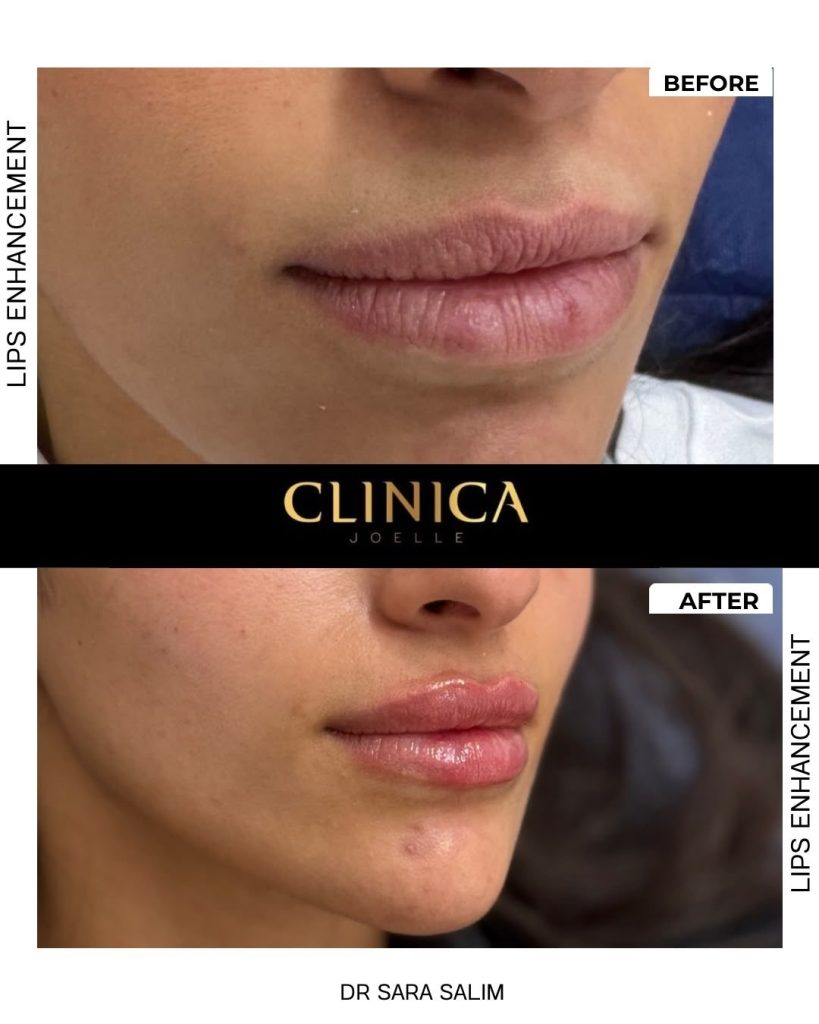 Lips enhancement – Dr Sara Salim