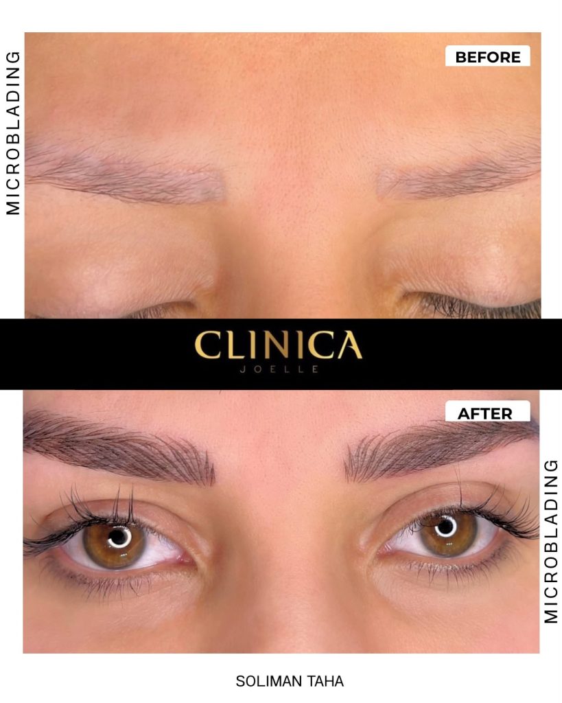 Microblading – before and after