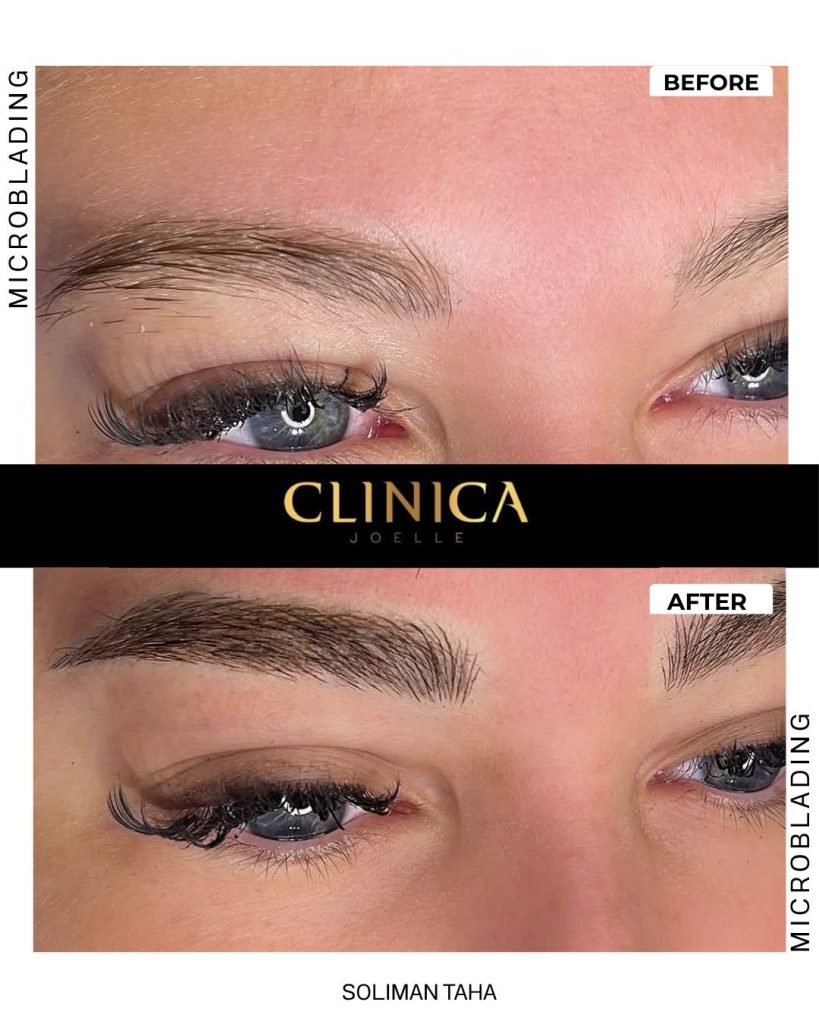Microblading II – Soliman Taha