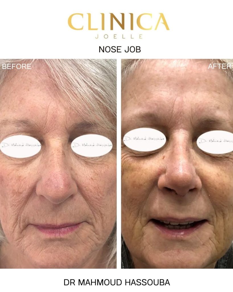 Nose job – Dr Mahmoud Hassouba