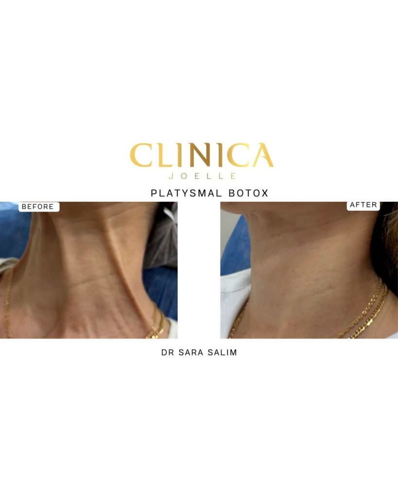 Platysmal botox – Dr Sara Salim