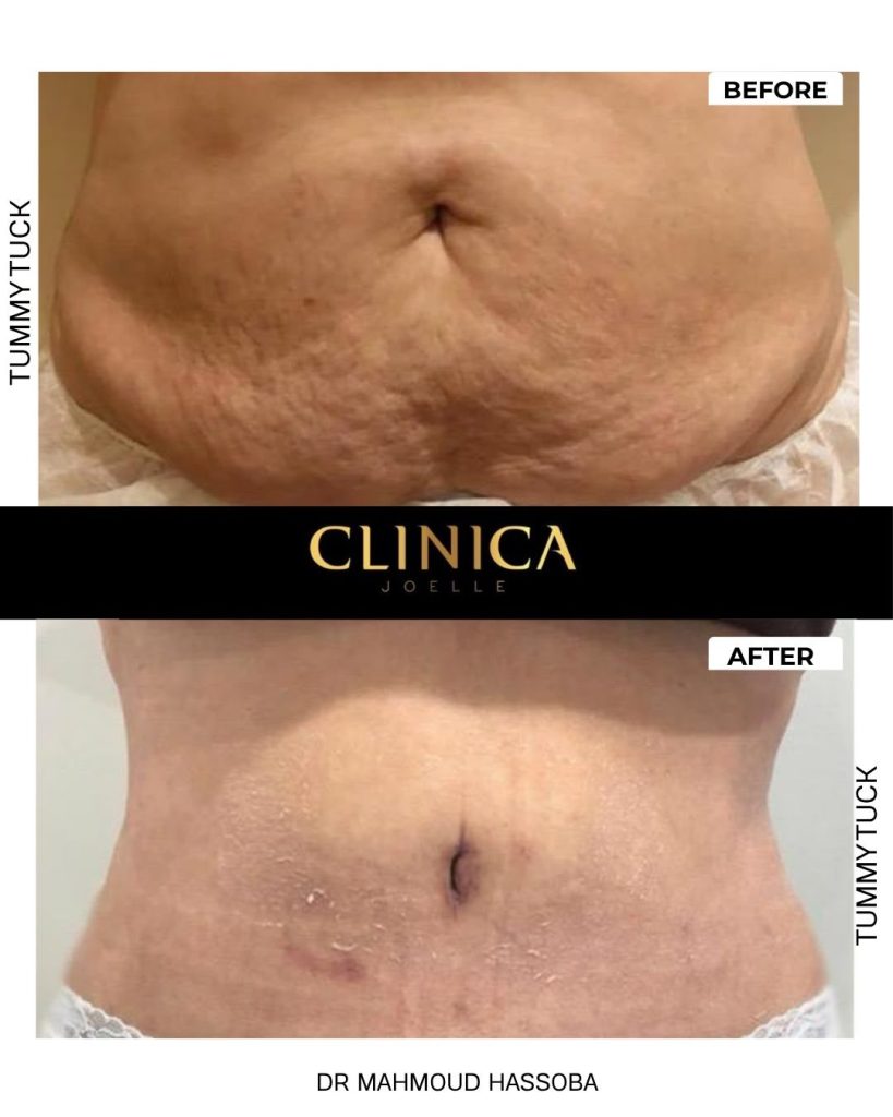 Tummy tuck – Dr Mahmoud Hassouba