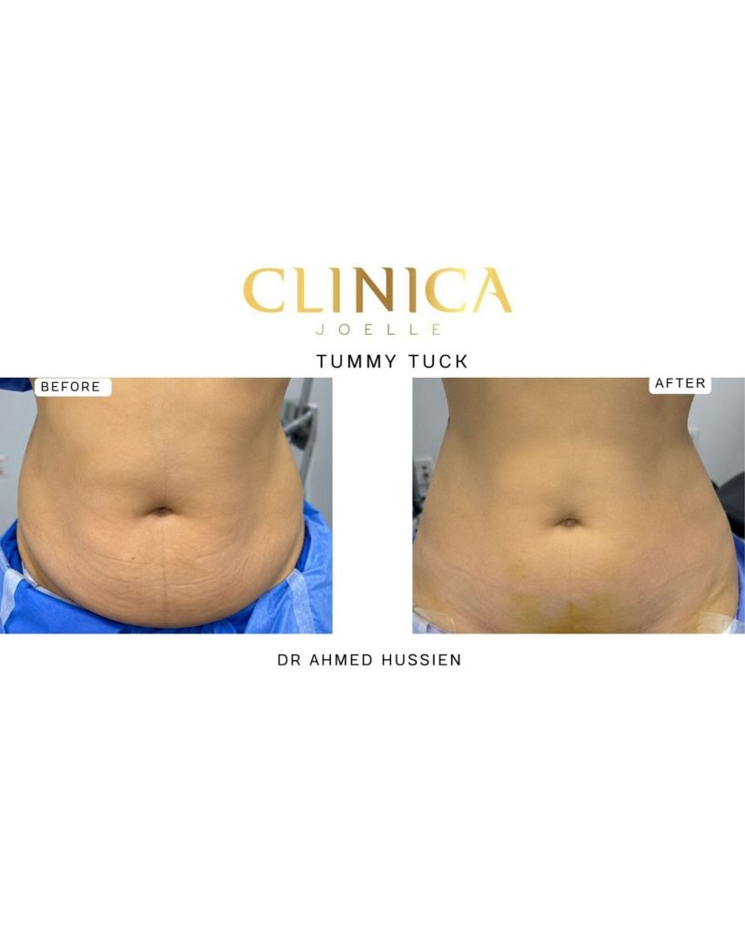 Tummy tuck – Dr Ahmed Hussien
