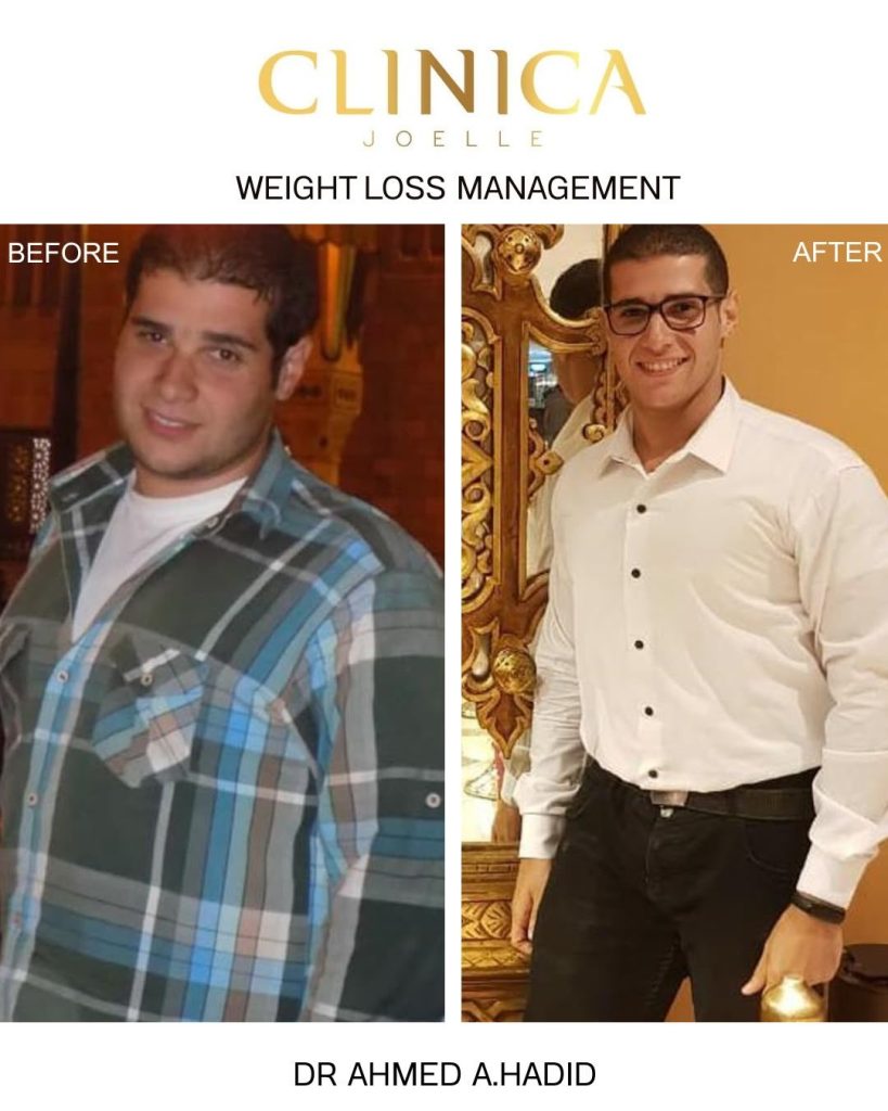 Weight loss management – Dr Ahmed Abu Hadid