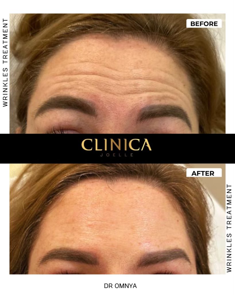 Wrinkles treatment – before and after