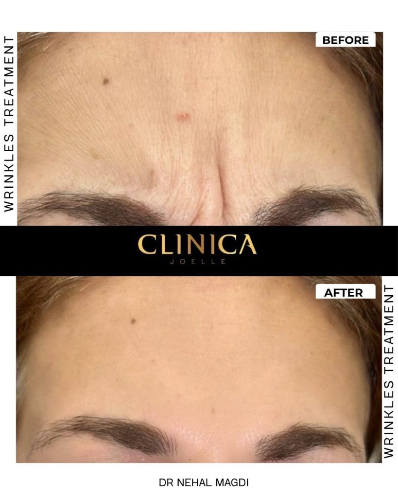 Wrinkles treatment – Dr Nehal Magdi